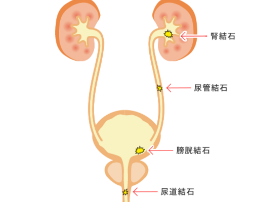 尿管結石