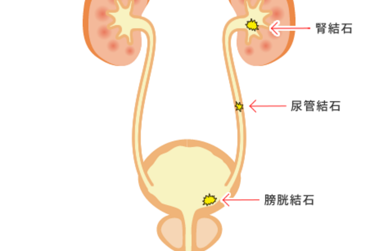 尿管結石